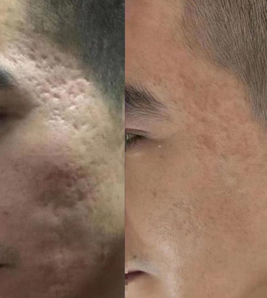 Acne scars · 2 treatments: before and after treatment with CO₂LD