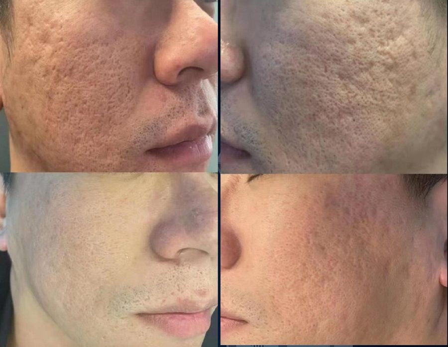 Ice pick scars · 2 treatments: before and after treatment with CO₂LD