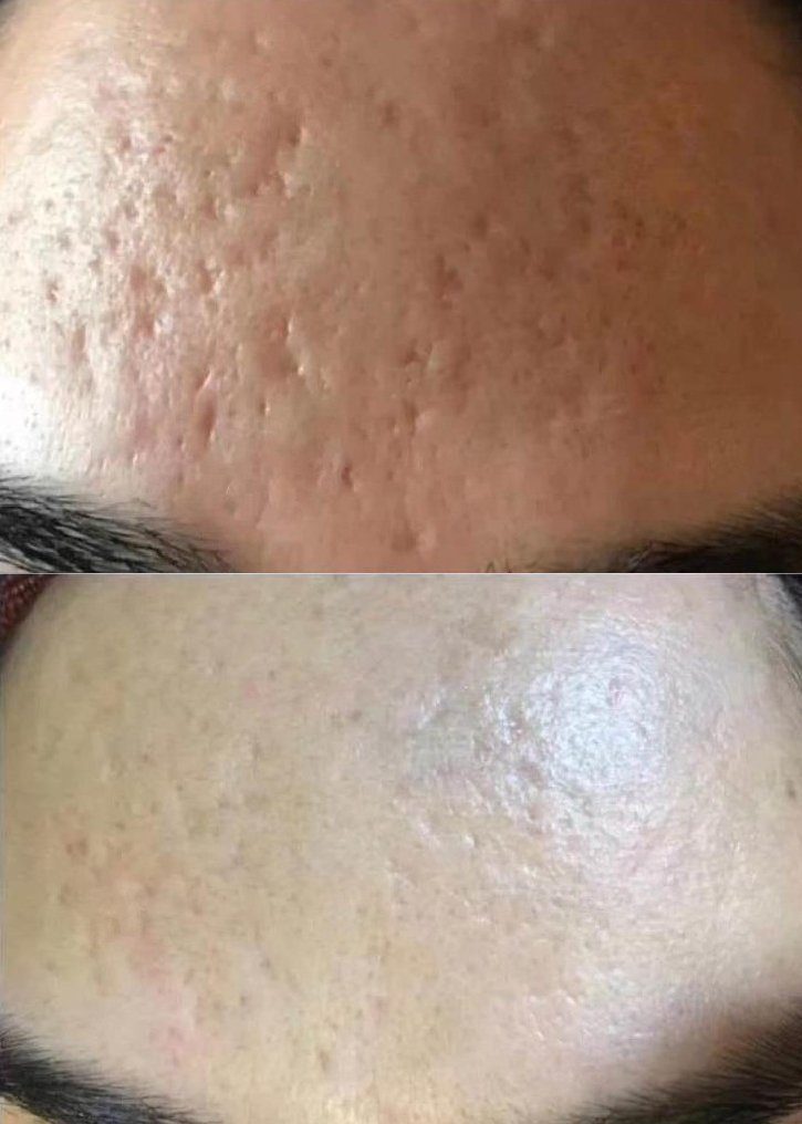 Forehead acne scars · 1 treatment: before and after treatment with CO₂LD