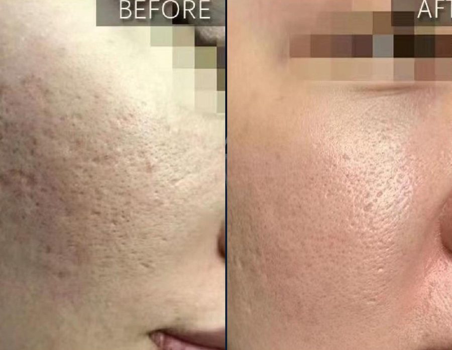 Acne scars · 1 treatment: before and after treatment with CO₂LD