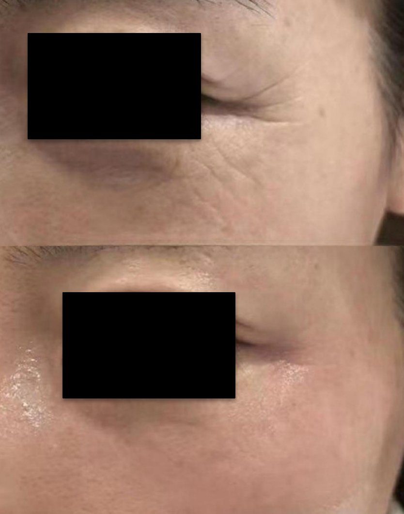 Peri-orbital wrinkles · 1 treatment: before and after treatment with CO₂LD