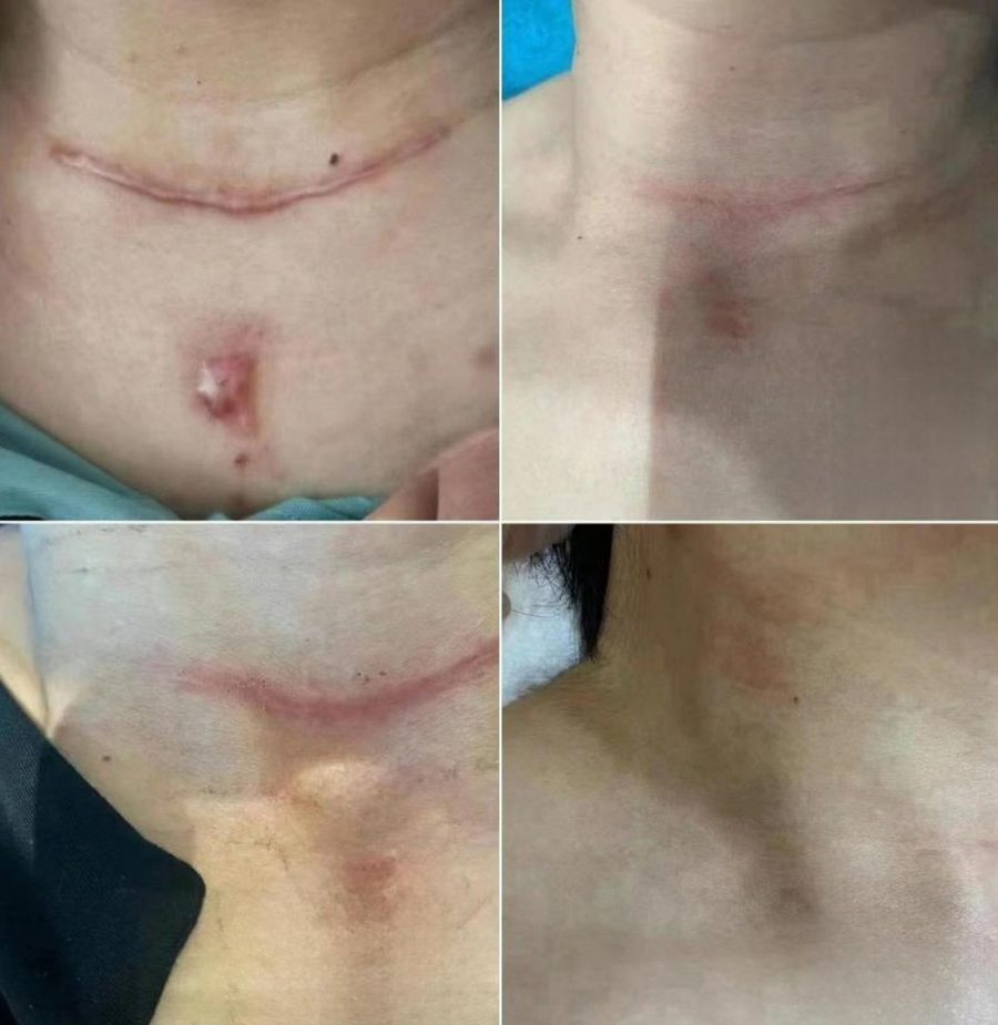 Keloid scars · multi-modal: before and after treatment with CO₂LD