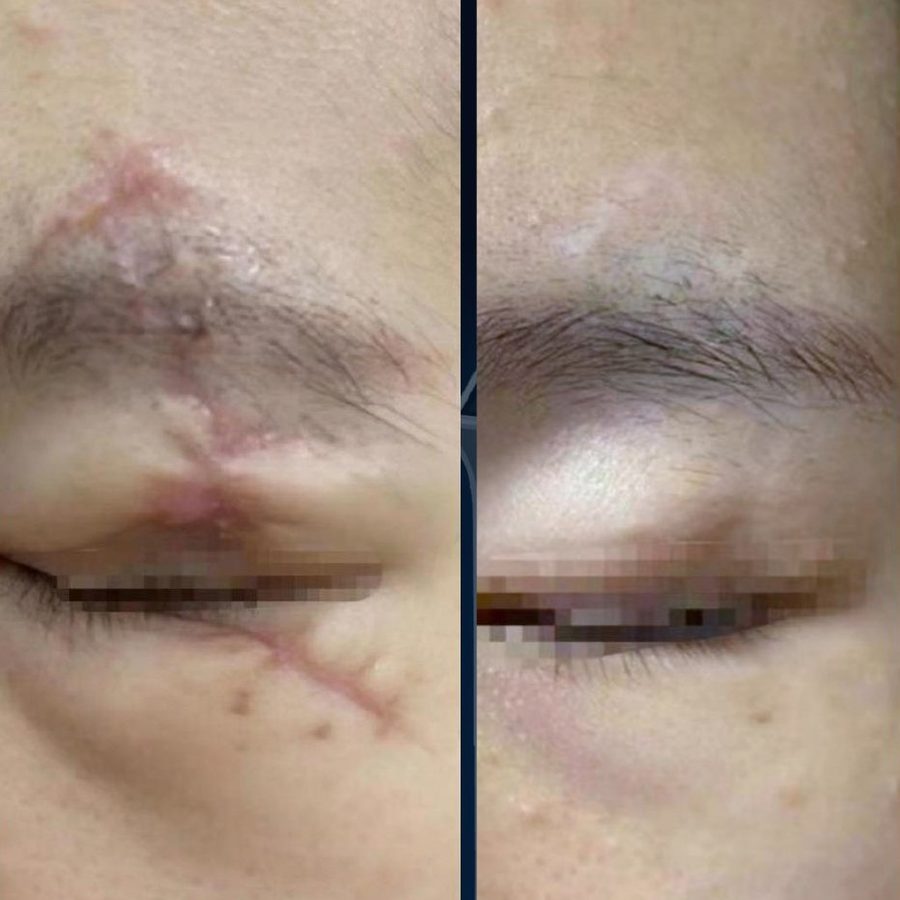 Traumatic scar · 2 treatments: before and after treatment with CO₂LD