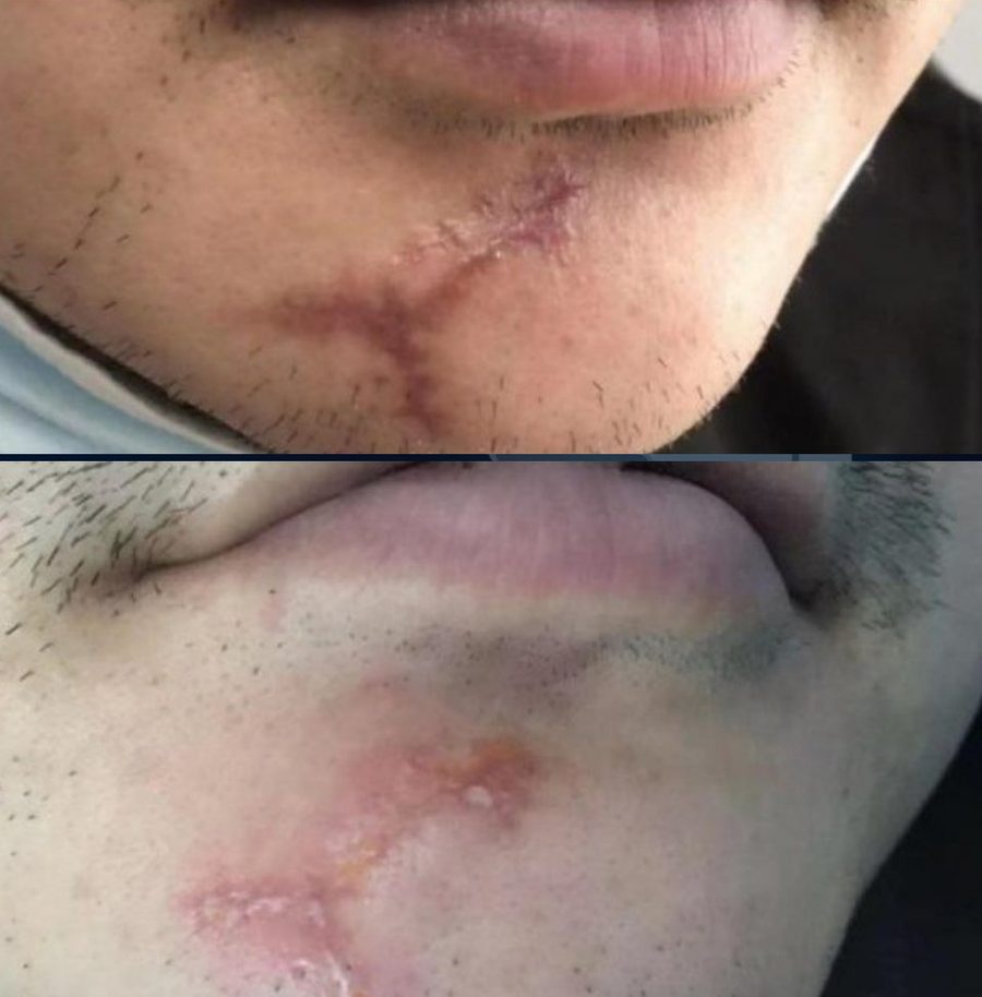 Traumatic scar · 1 treatment: before and after treatment with CO₂LD