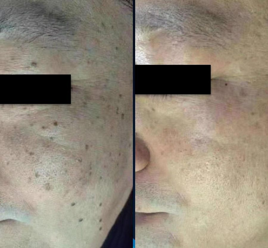 Moles · 1 treatment: before and after treatment with CO₂LD