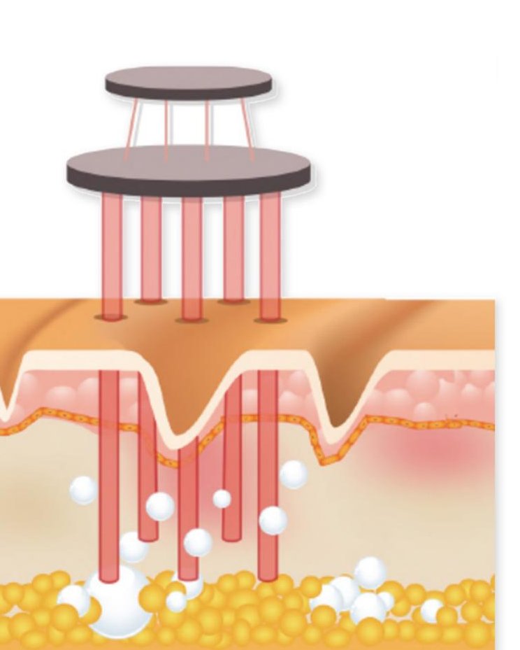 Diagram of fractional CO₂ beams creating micro-thermal zones in the skin