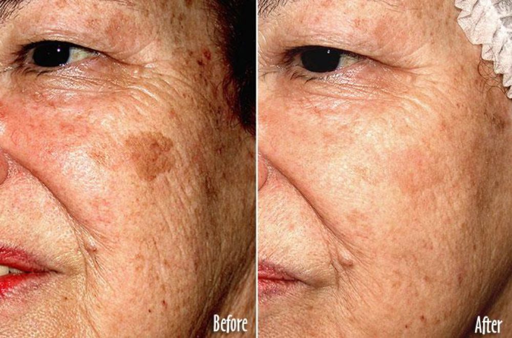 Pigmented lesions (lentigines): before and after treatment with VersaLASE