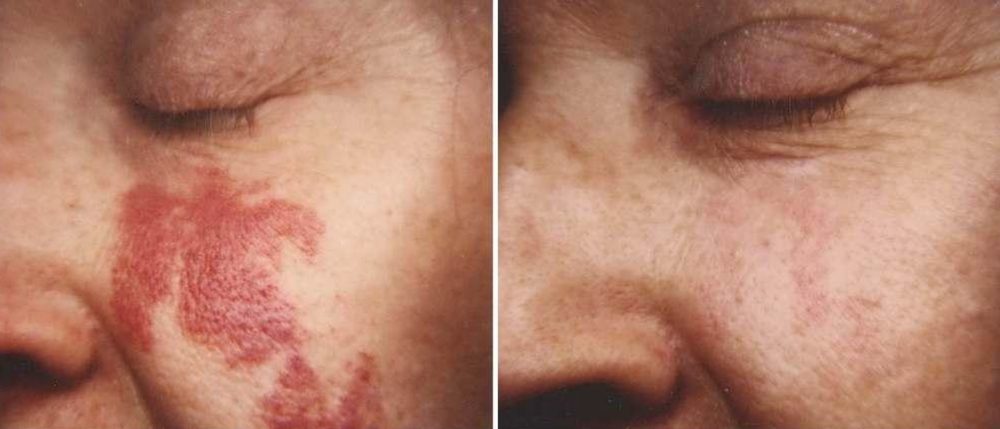 Port-wine stain: before and after treatment with VersaLASE