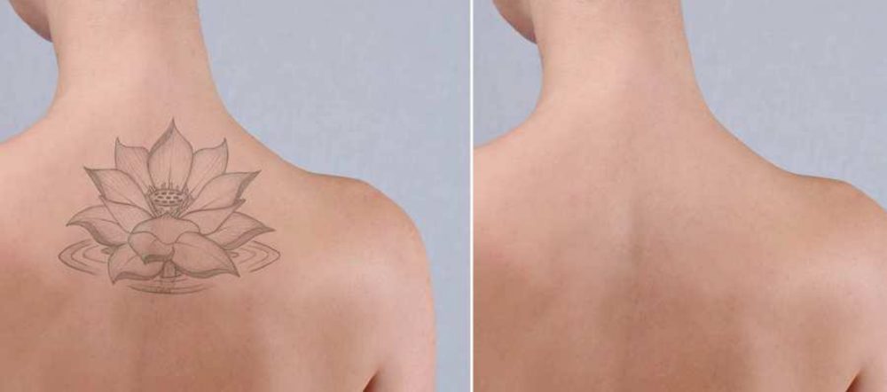 Tattoo removal: before and after treatment with VersaLASE